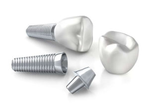 インプラントに寿命ってあるの？