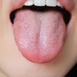 舌に歯の跡がついている！！～舌のふちをみてみよう～